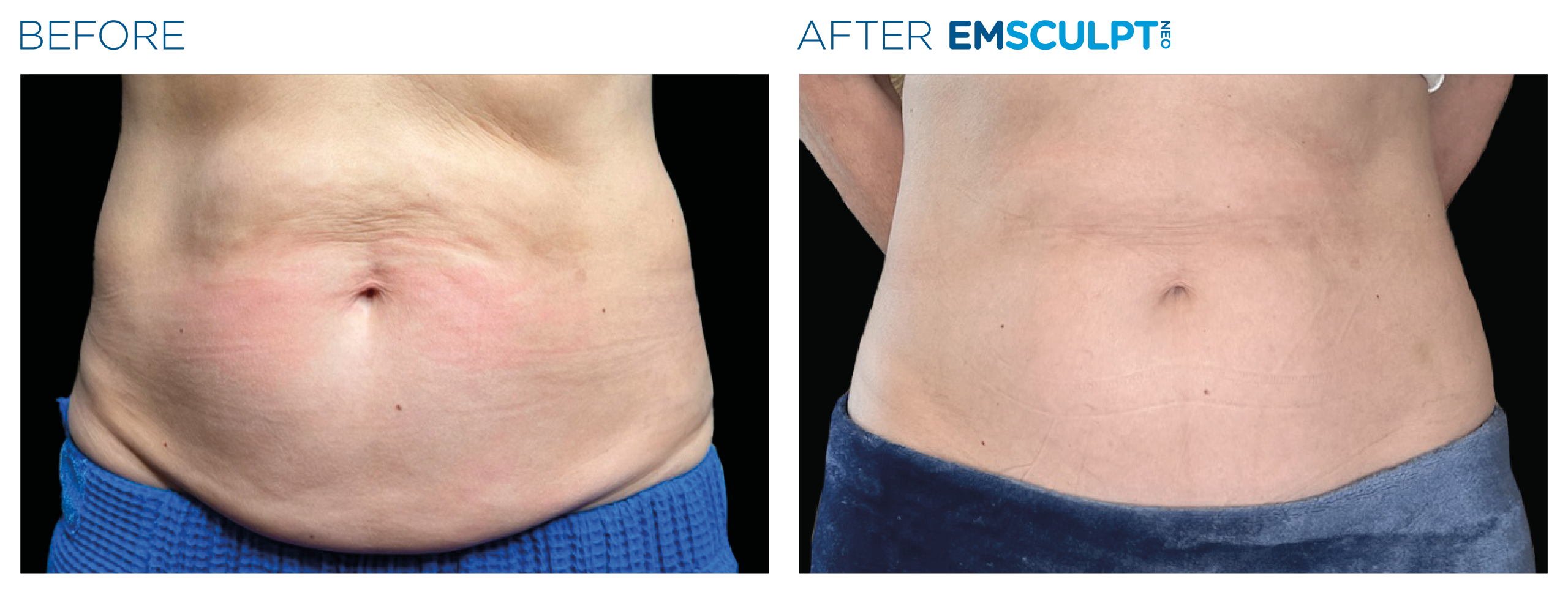 Emsculpt_Neo_PIC_Ba-card-female-abdomen-139_ENUS100