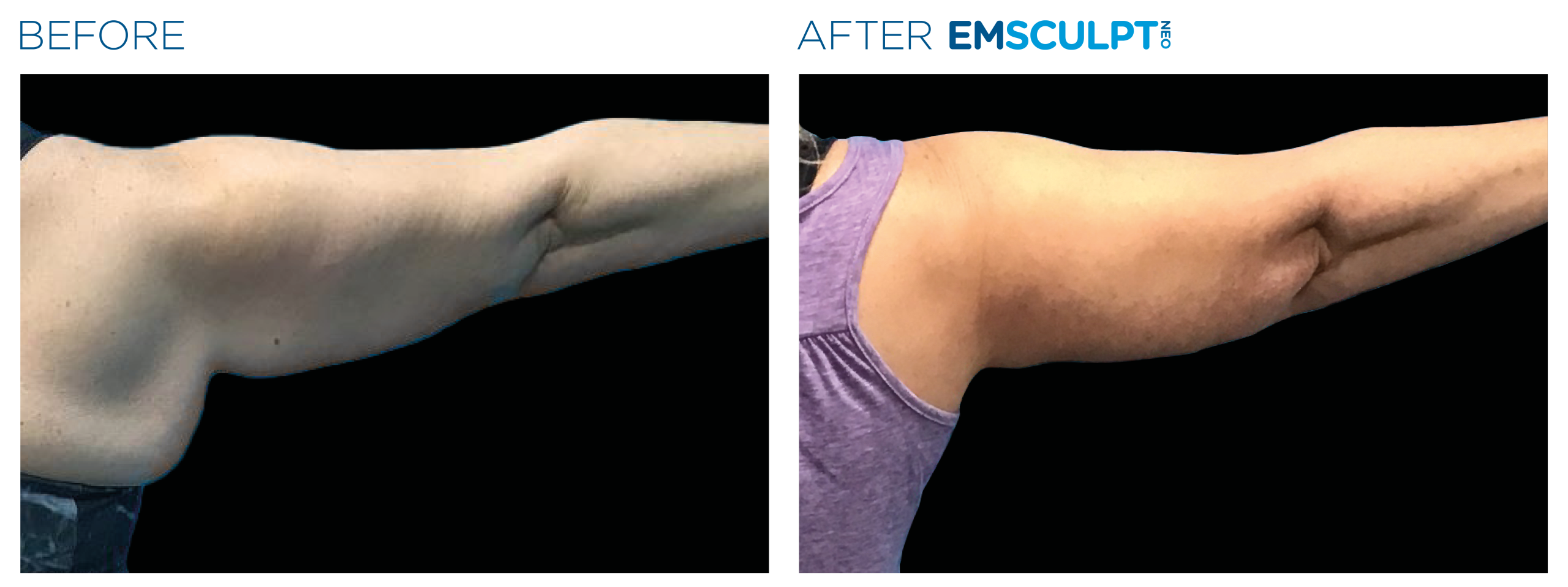 Emsculpt_Neo_PIC_Ba-card-female-arms-078_ENUS100