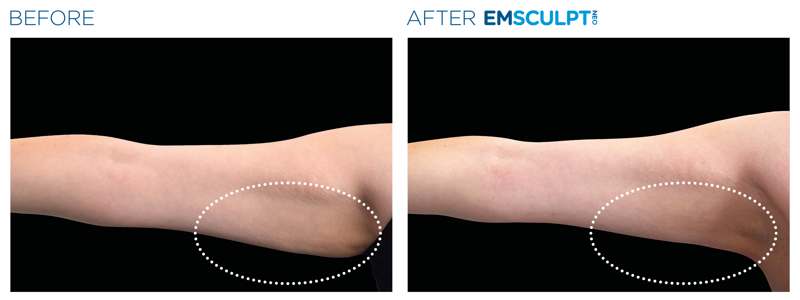 Emsculpt_Neo_PIC_Ba-card-female-arms-099_ENUS100