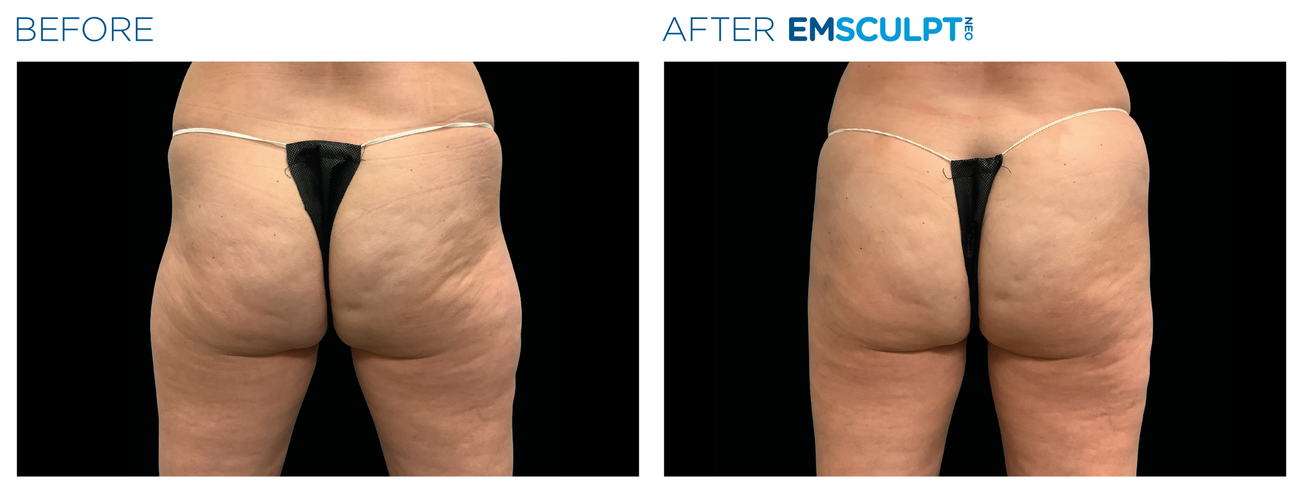 Emsculpt_Neo_PIC_Ba-card-female-buttock-097_ENUS100