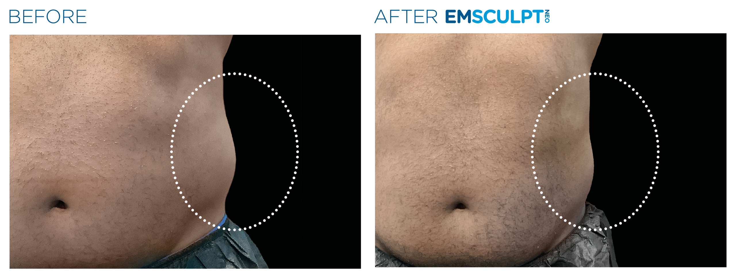 Emsculpt_Neo_PIC_Ba-card-female-lateral-abdomen-158_ENUS100