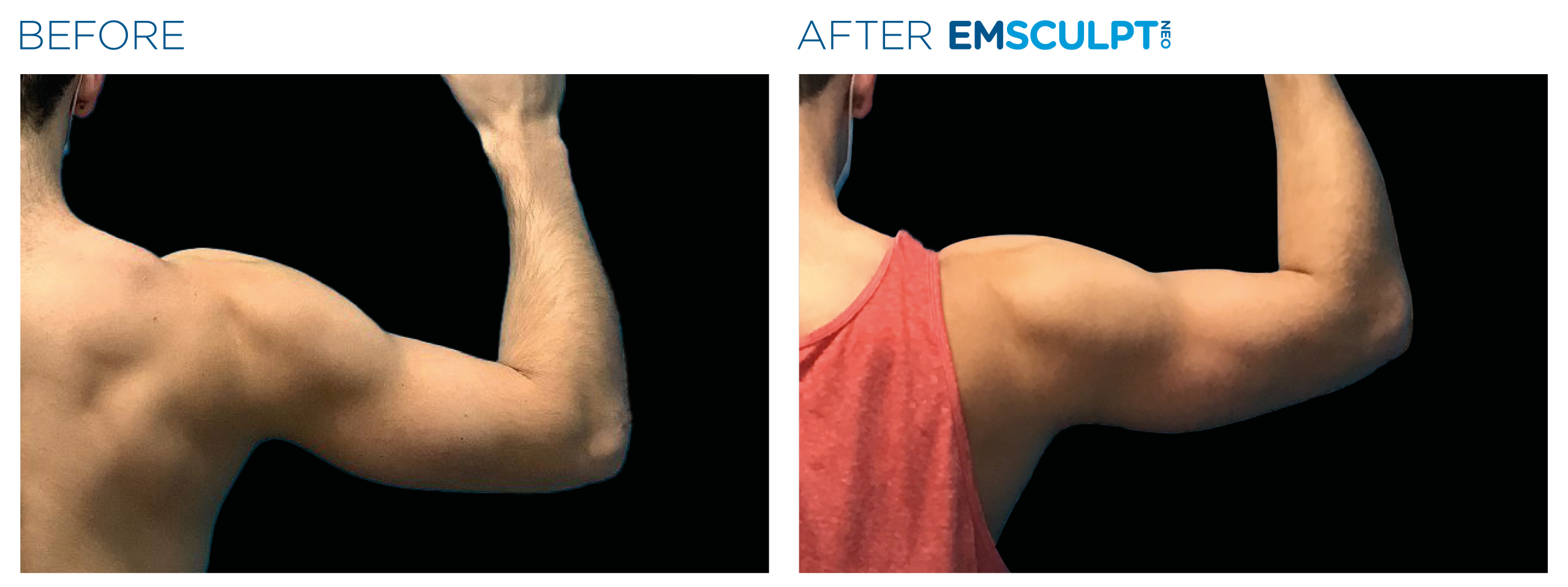 Emsculpt_Neo_PIC_Ba-card-male-arms-077_ENUS100