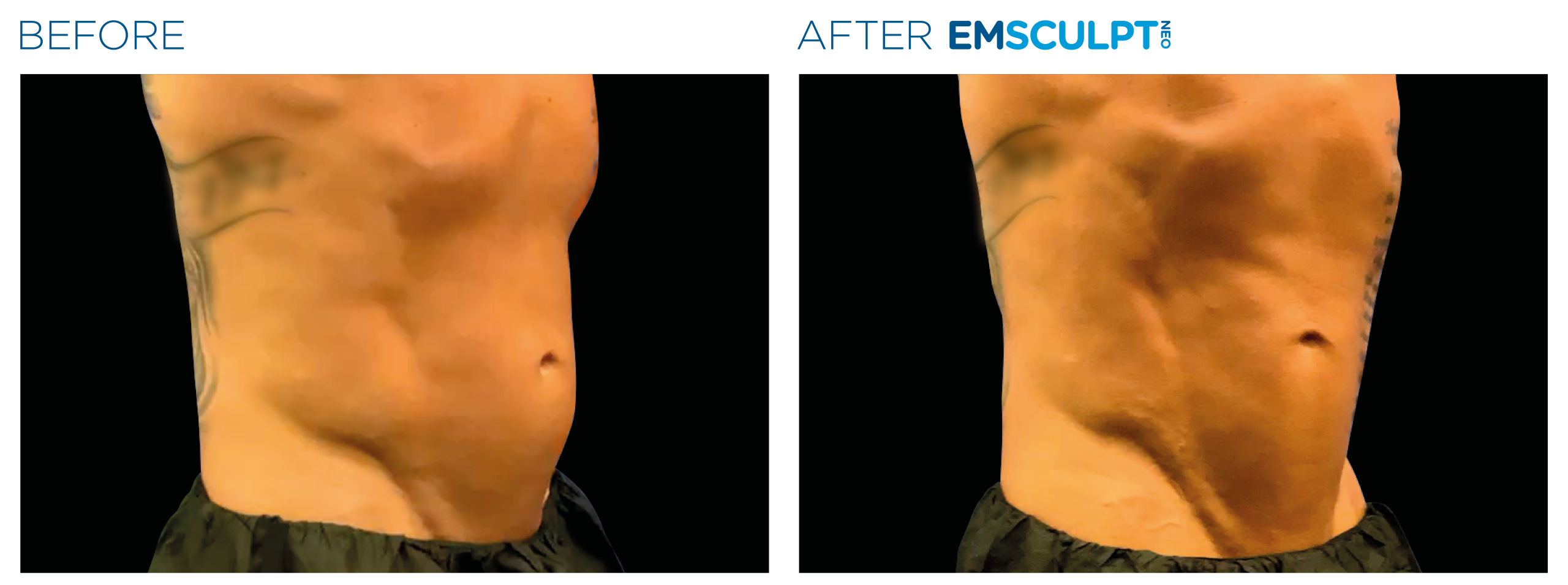 Emsculpt_Neo_PIC_Ba-card-male-lateral-abdomen-123_ENUS100