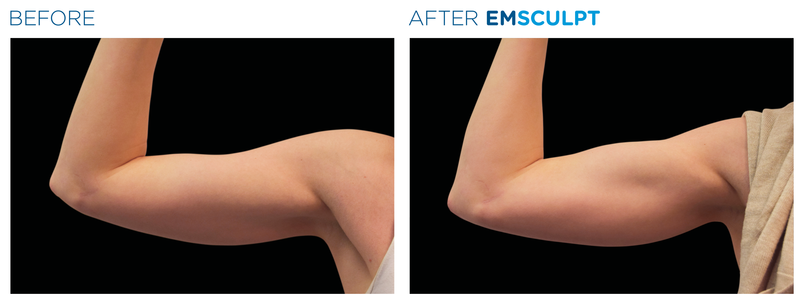 Emsculpt_PIC_Ba-card-female-arms-078_For-neo_ENUS100