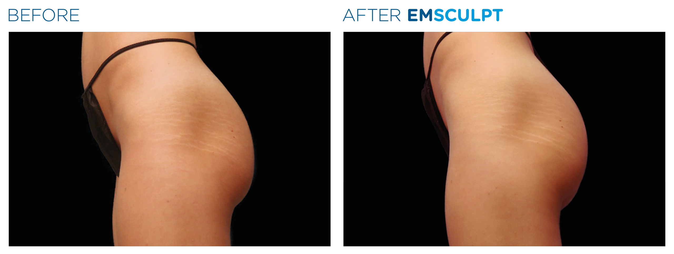 Emsculpt_PIC_Ba-card-female-buttock-021_For-neo_ENUS100