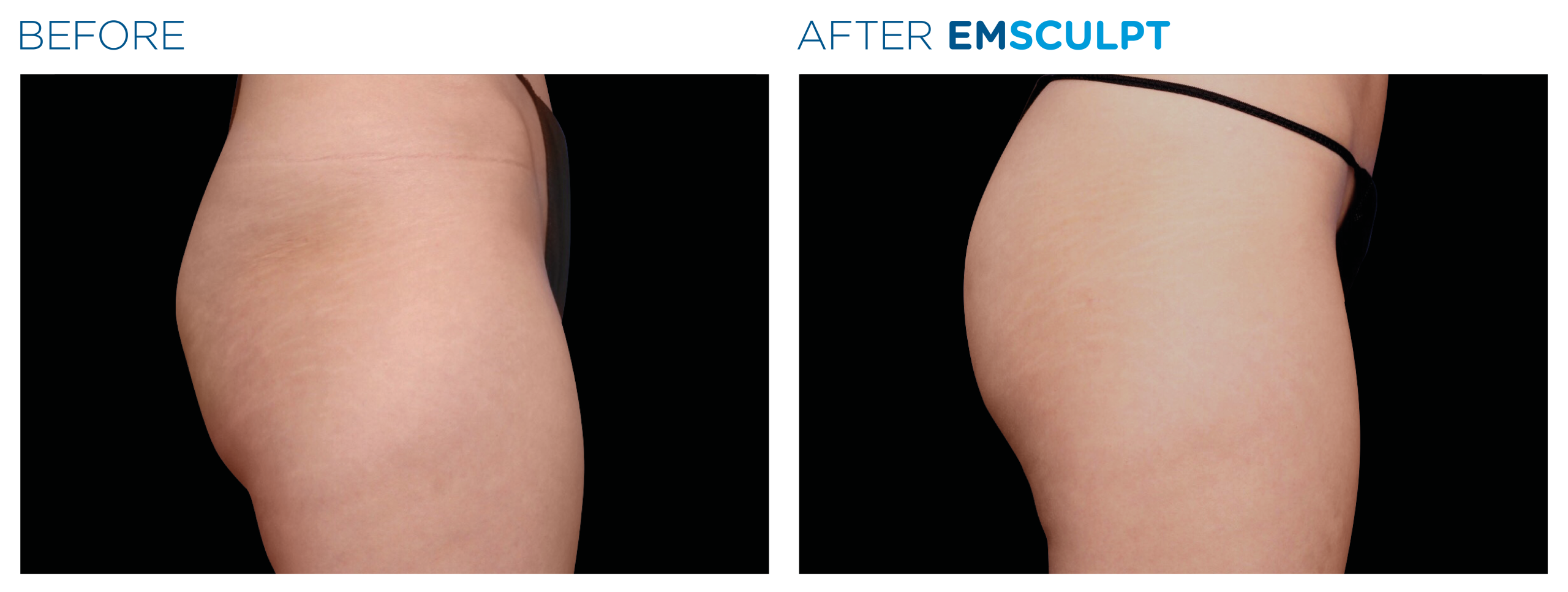 Emsculpt_PIC_Ba-card-female-buttock-049_For-neo_ENUS100