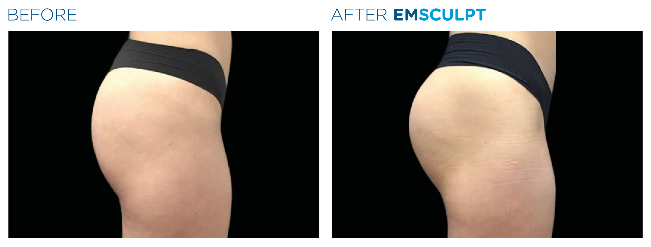 Emsculpt_PIC_Ba-card-female-buttock-094_For-neo_ENUS100