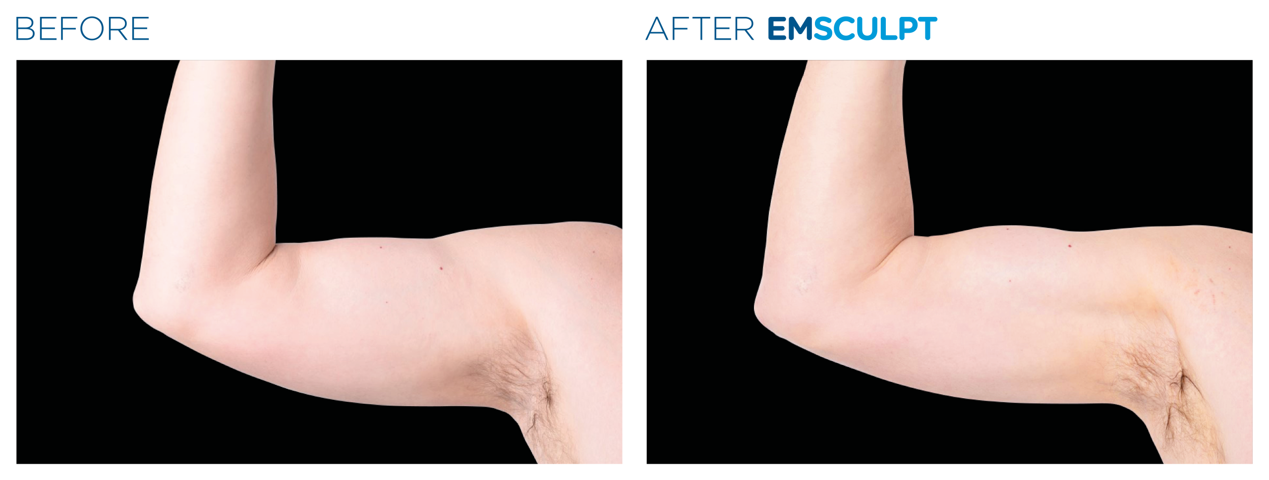 Emsculpt_PIC_Ba-card-male-arms-118_For-neo_EN100