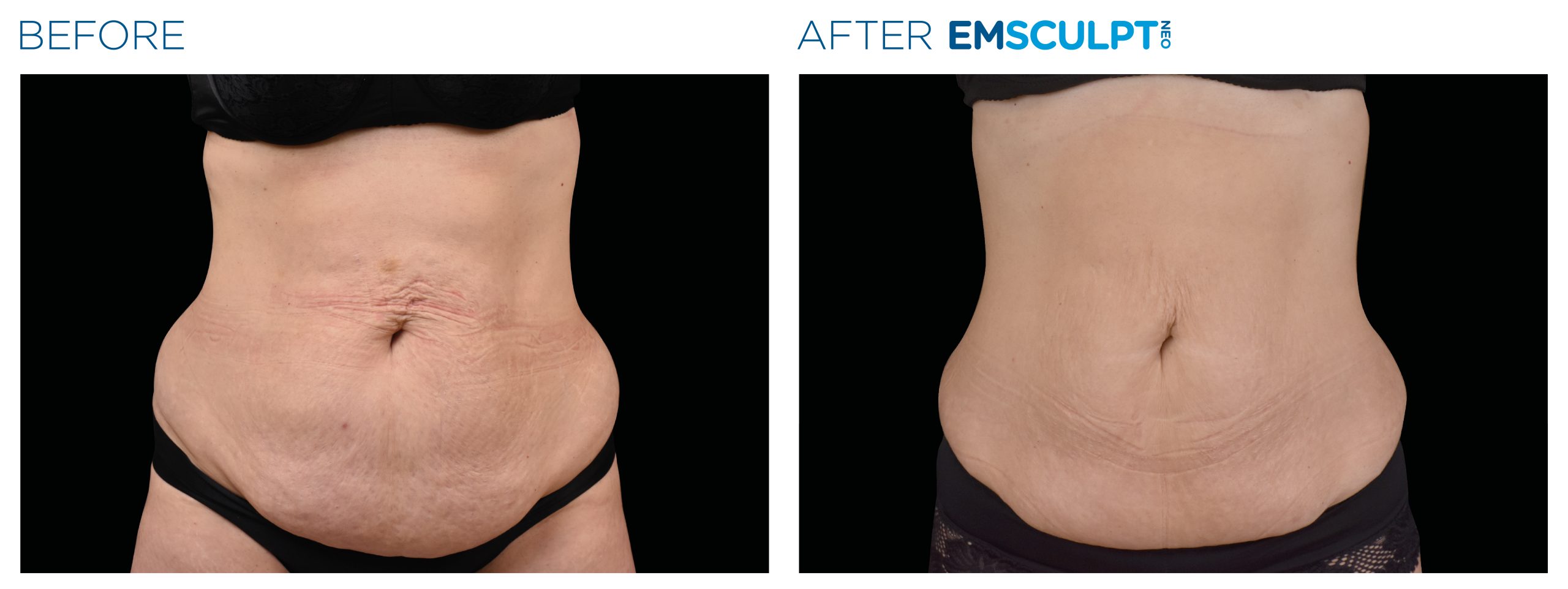Emsculpt_neo_PIC_Ba-card-female-abdomen-009_EN100