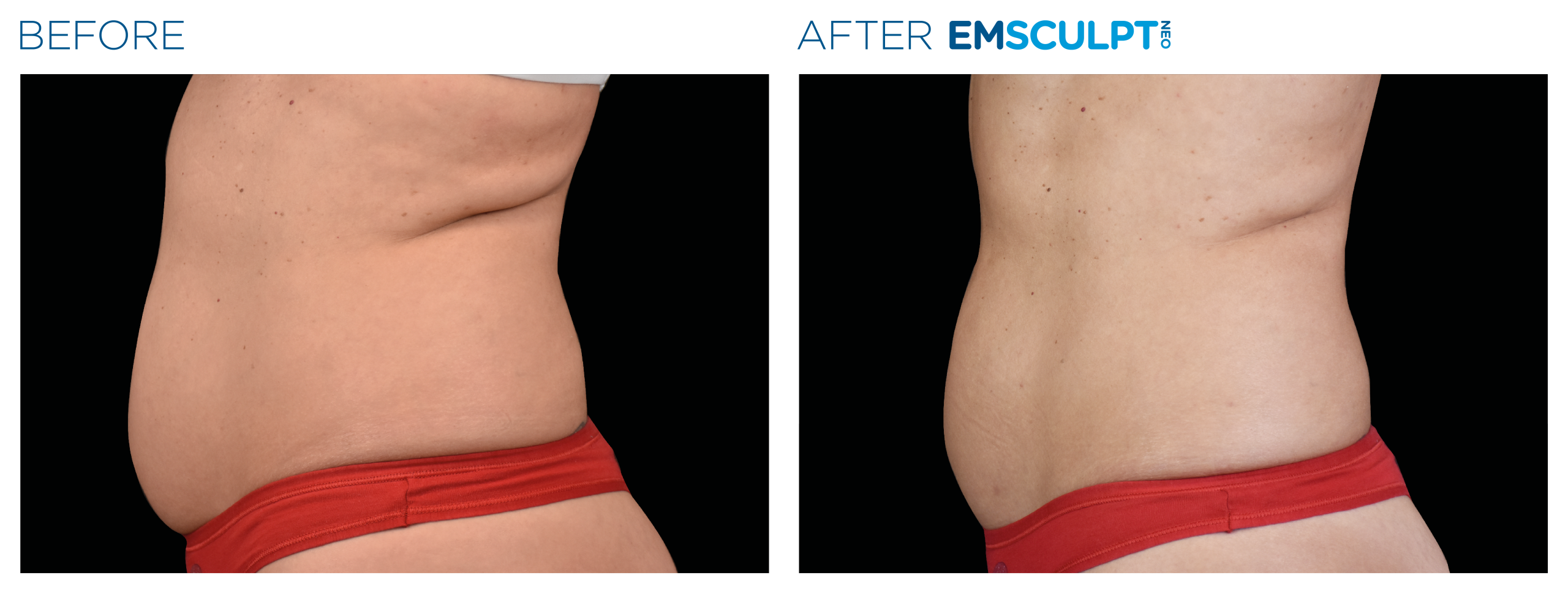 Emsculpt_neo_PIC_Ba-card-female-abdomen-017_EN100