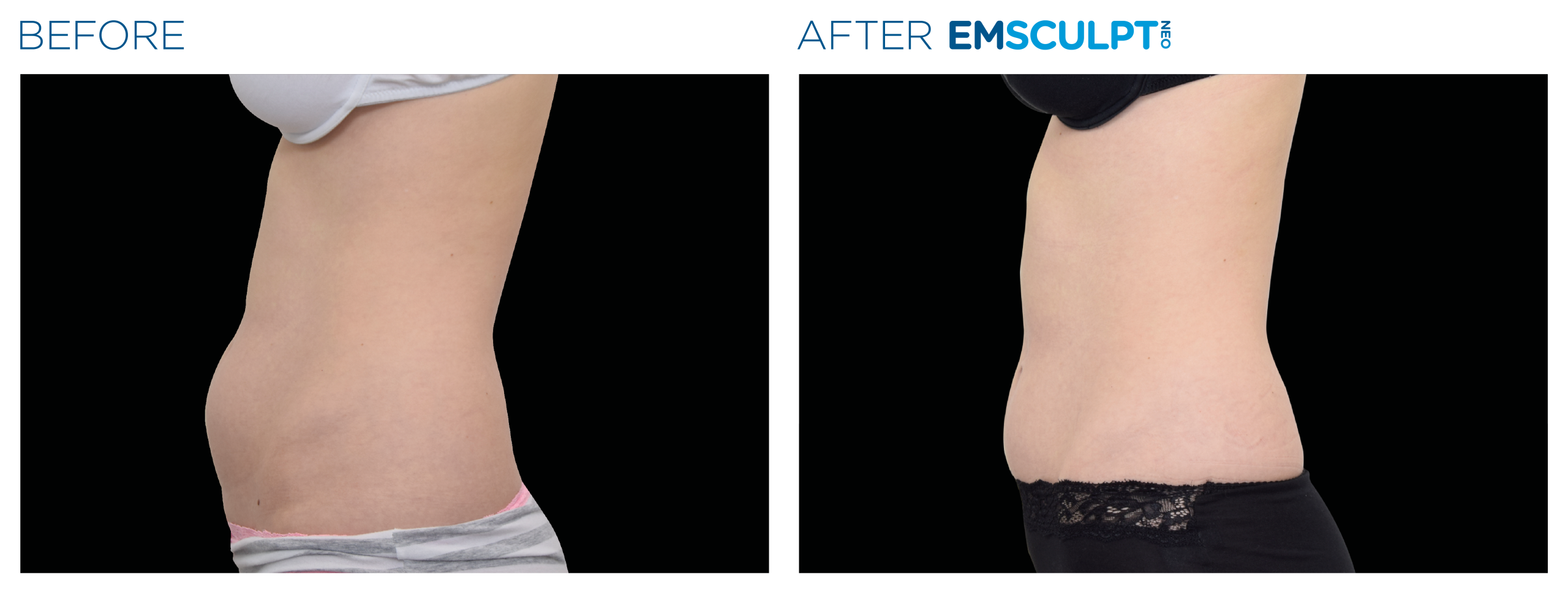 Emsculpt_neo_PIC_Ba-card-female-abdomen-024_EN100