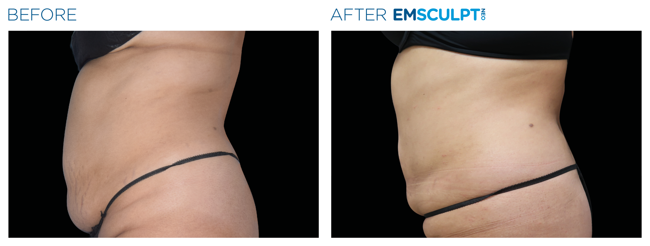 Emsculpt_neo_PIC_Ba-card-female-abdomen-033_EN100