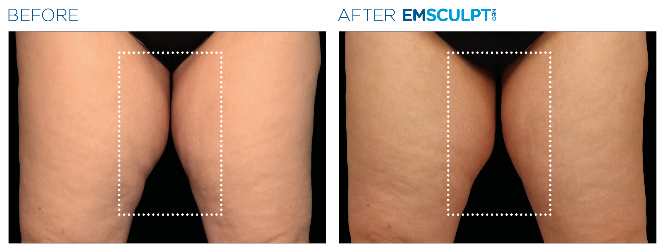 Emsculpt_neo_PIC_Ba-card-female-inner_thighs-063_ENUS100