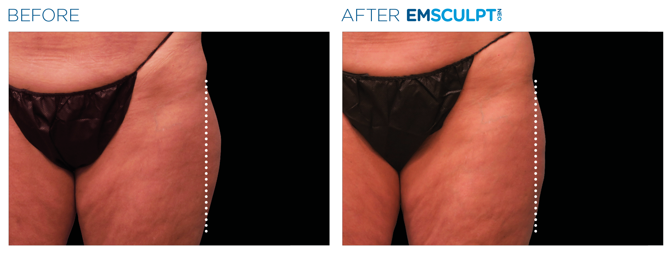 Emsculpt_neo_PIC_Ba-card-female-outer_thighs-049_ENUS100