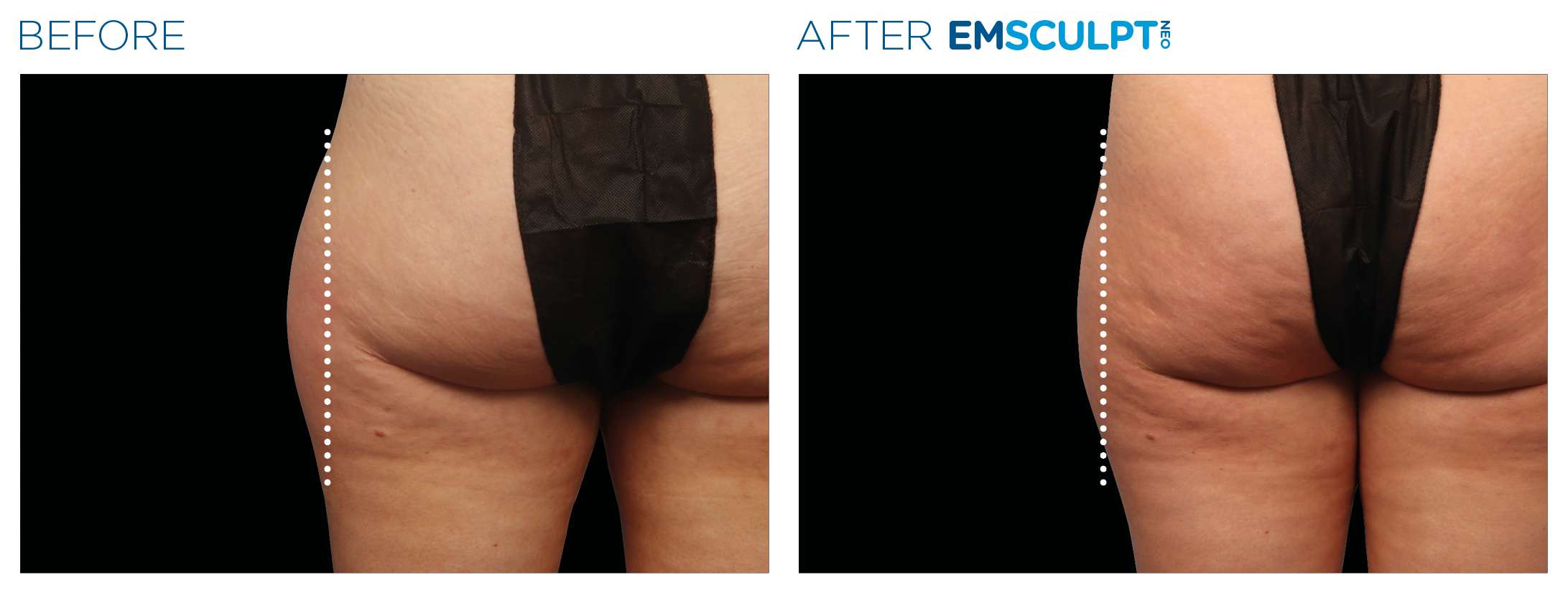 Emsculpt_neo_PIC_Ba-card-female-outer_thighs-053_ENUS100