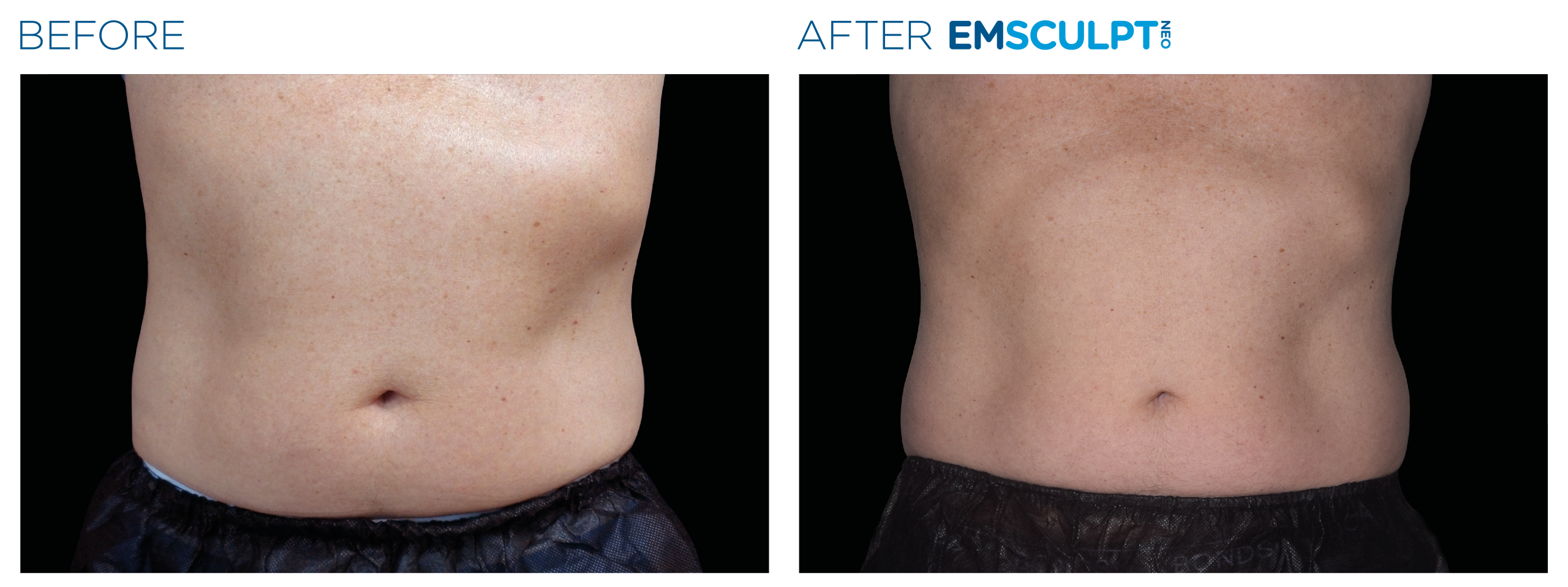 Emsculpt_neo_PIC_Ba-card-male-abdomen-043_EN100
